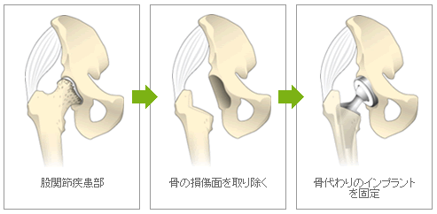 人工股関節置換術
