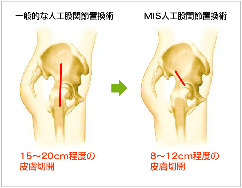 手術後の傷跡が小さくなります。