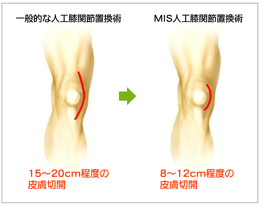 手術後の傷跡が小さくなります