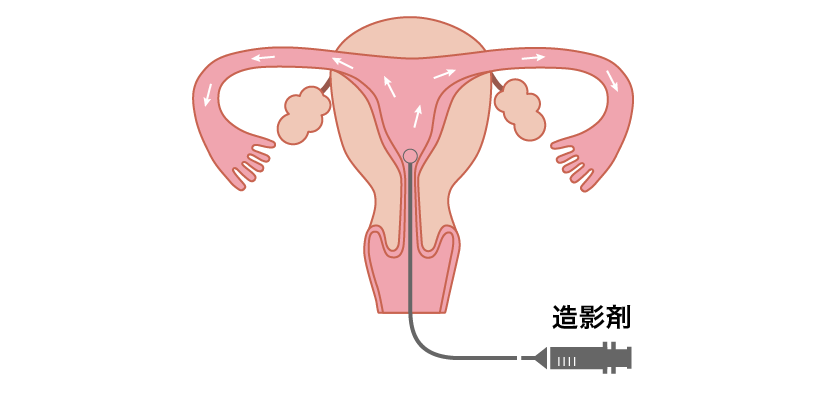 063_1（卵管造影）.png