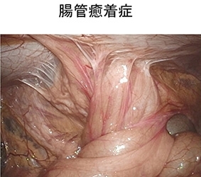 腸管癒着症