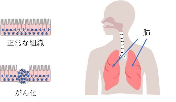 肺がんとは