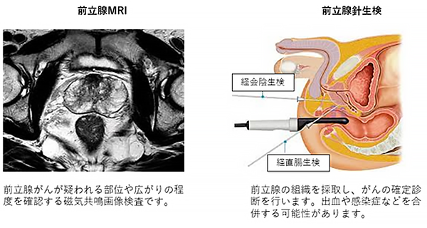 前立腺MRI 前立腺針生検