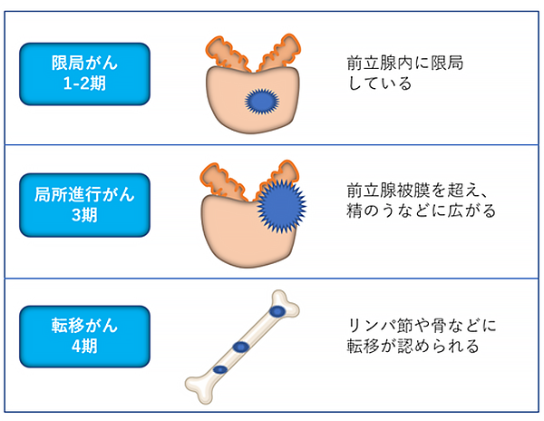 前立腺がんステージ図