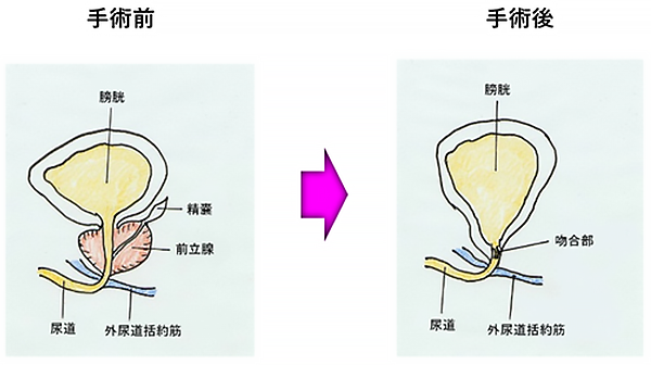 手術療法（根治的前立腺全摘除術）①