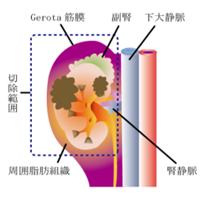 腎摘除術