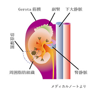 腎部分切除術