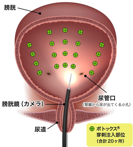 ボツリヌス毒素膀胱壁内注入療法イメージ画像