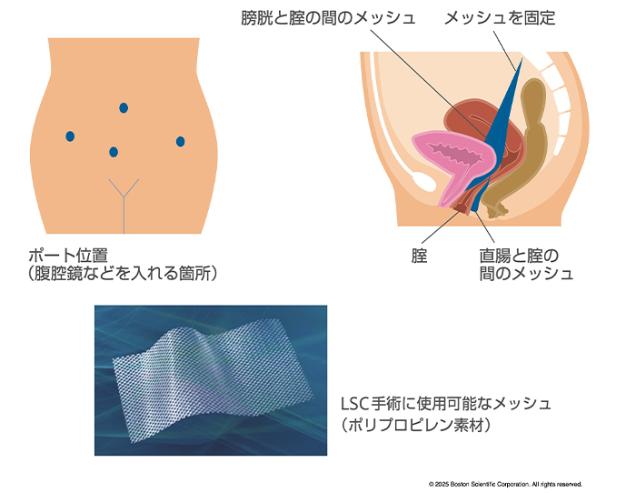LSCについて