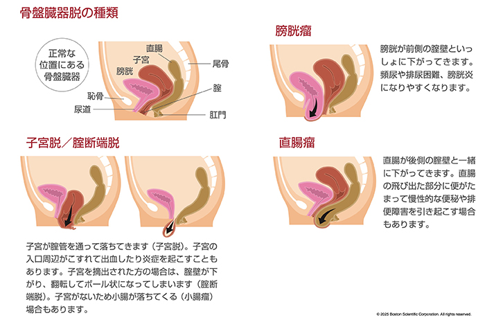 骨盤臓器脱の種類