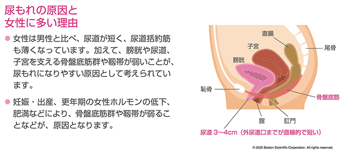 尿漏れの原因