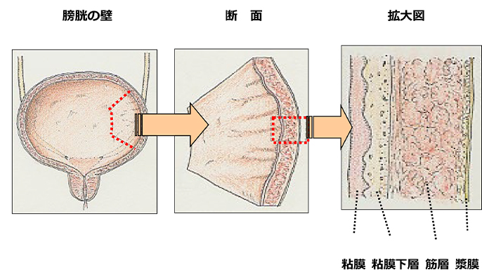膀胱がん図1