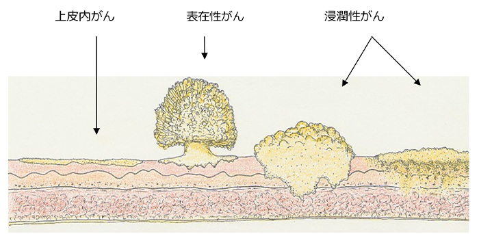 膀胱がん図2