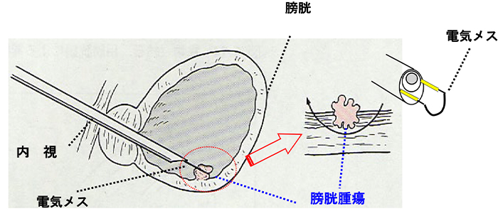 膀胱がん図3
