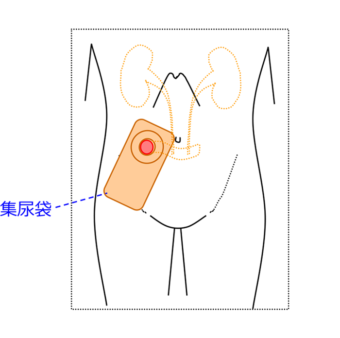 膀胱がん図4