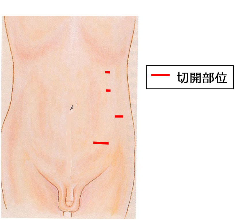 【図3】手術の創（左側摘出の一例）