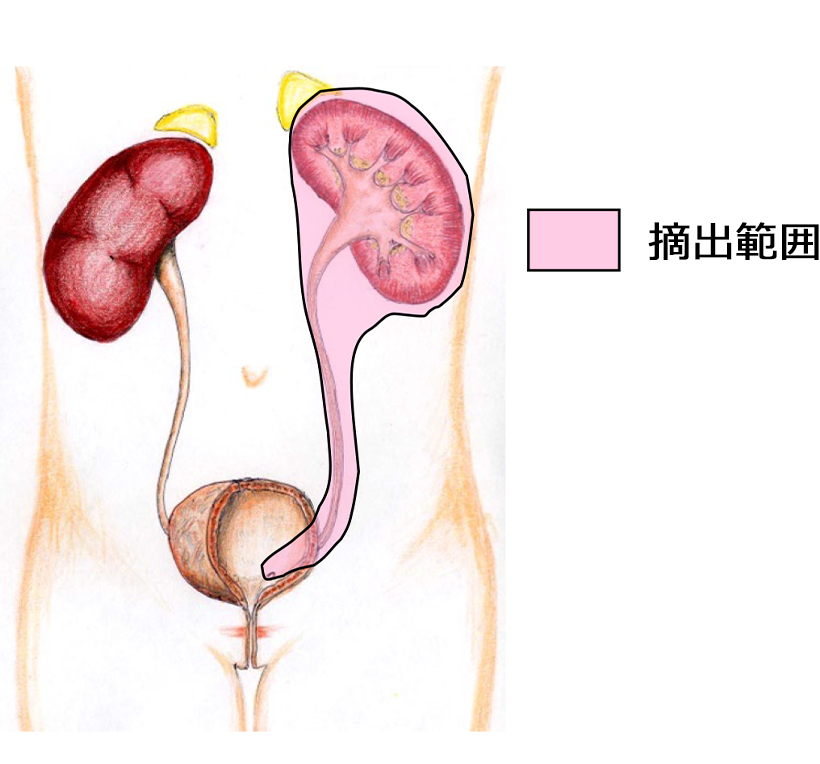 【図4】摘出範囲（左側の場合）